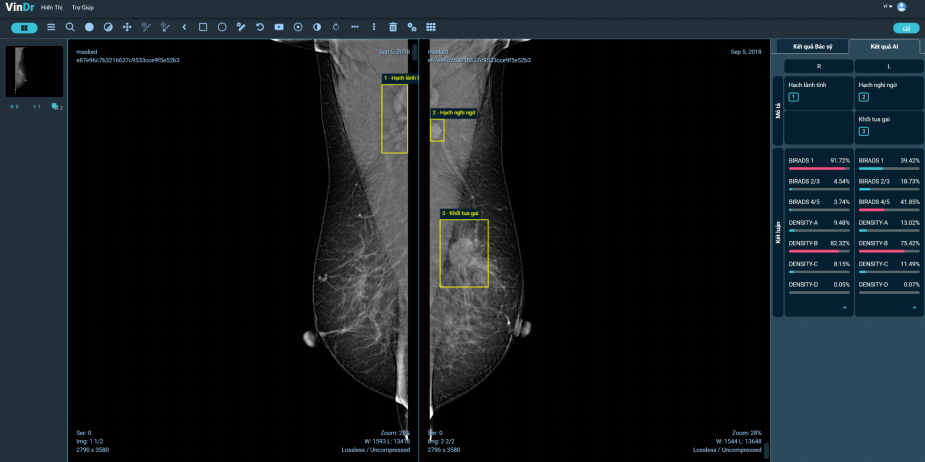 AI accurately classifies breast density •